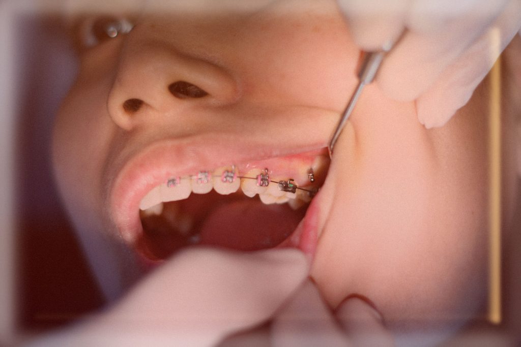 Rüyada Diş Düşmesi